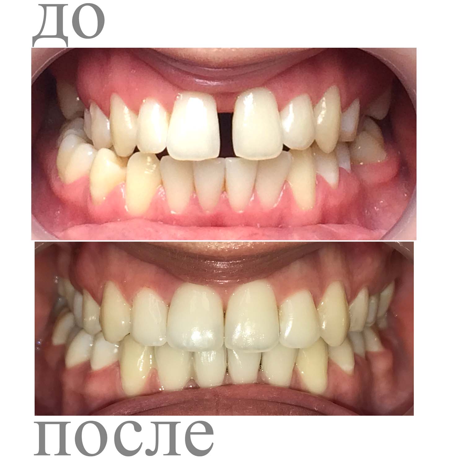 коррекция зубов фото
