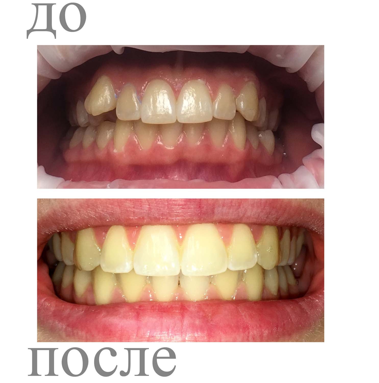 Зубы после брекетов. Зубы после брекетов до и после. Зыби до и после брикеть. Выпрямление зубов до и после.