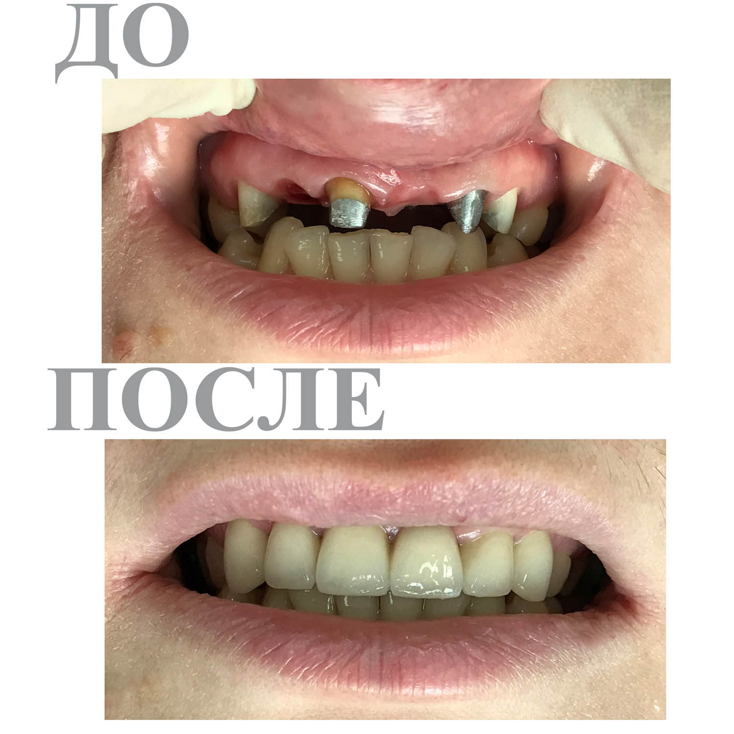 Протезирование зубов: фото до и после